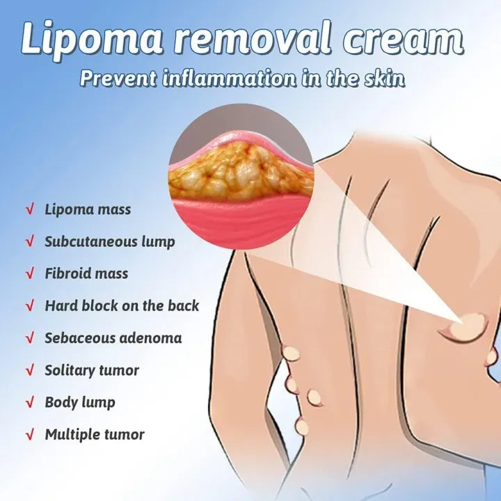 South Moon - Lipoma Removal Cream