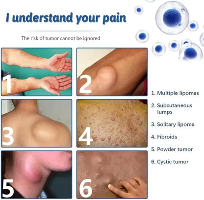 South Moon - Lipoma Removal Cream
